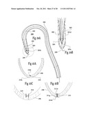 VENTRICULAR FUNCTION ASSISTING DEVICE AND A METHOD AND APPARATUS FOR     IMPLANTING IT diagram and image