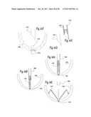 VENTRICULAR FUNCTION ASSISTING DEVICE AND A METHOD AND APPARATUS FOR     IMPLANTING IT diagram and image