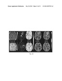 ESTIMATING AND CORRECTING FOR CONTRAST AGENT EXTRAVASATION IN TISSUE     PERFUSION IMAGING diagram and image