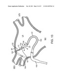 METHODS AND SYSTEMS FOR ABLATING TISSUE diagram and image