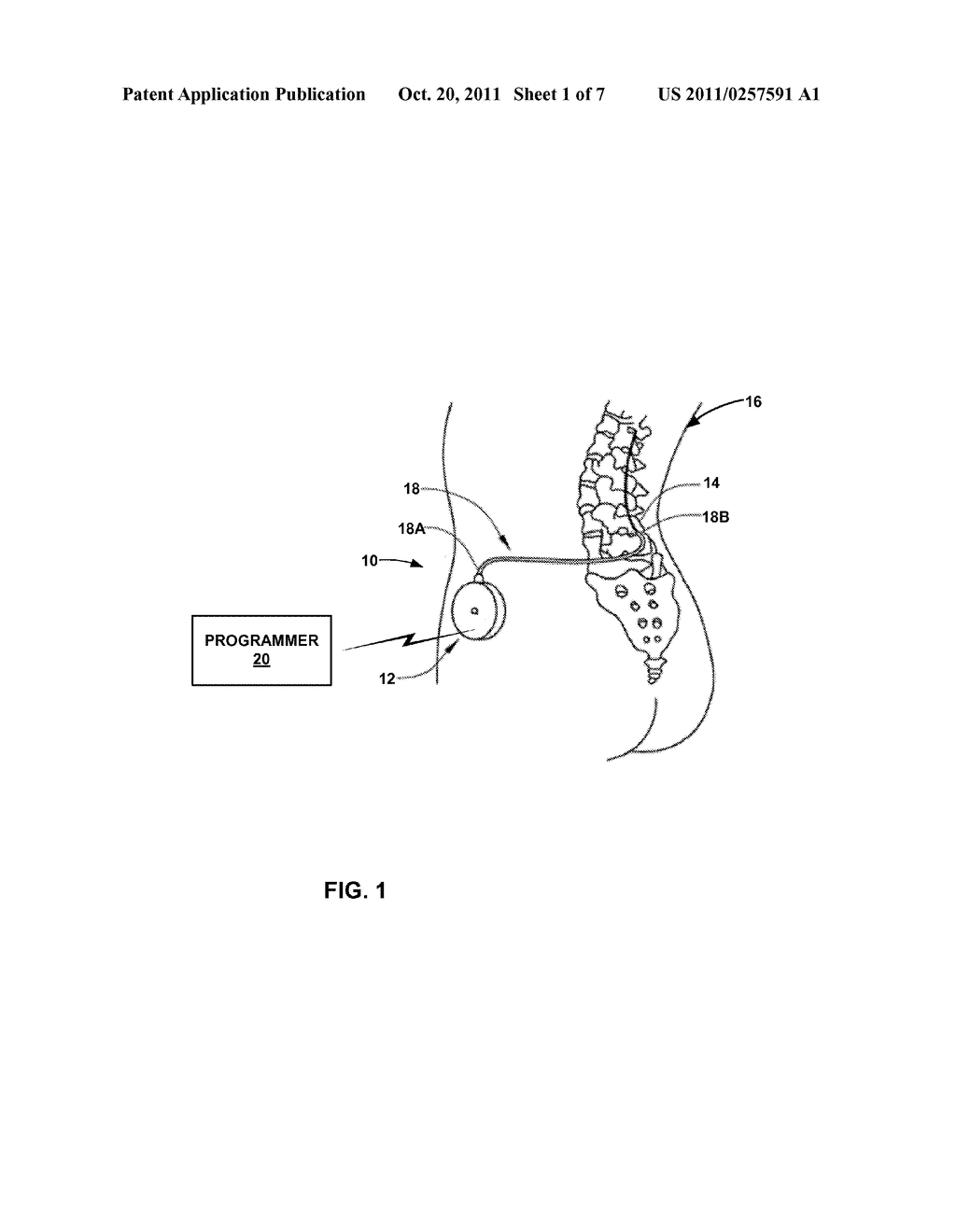 VOLUME MONITORING FOR IMPLANTABLE FLUID DELIVERY DEVICES - diagram, schematic, and image 02