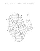 SYSTEMS, APPARATUSES, AND METHODS FOR SIZING A SUBCUTANEOUS,     REDUCED-PRESSURE TREATMENT DEVICE diagram and image