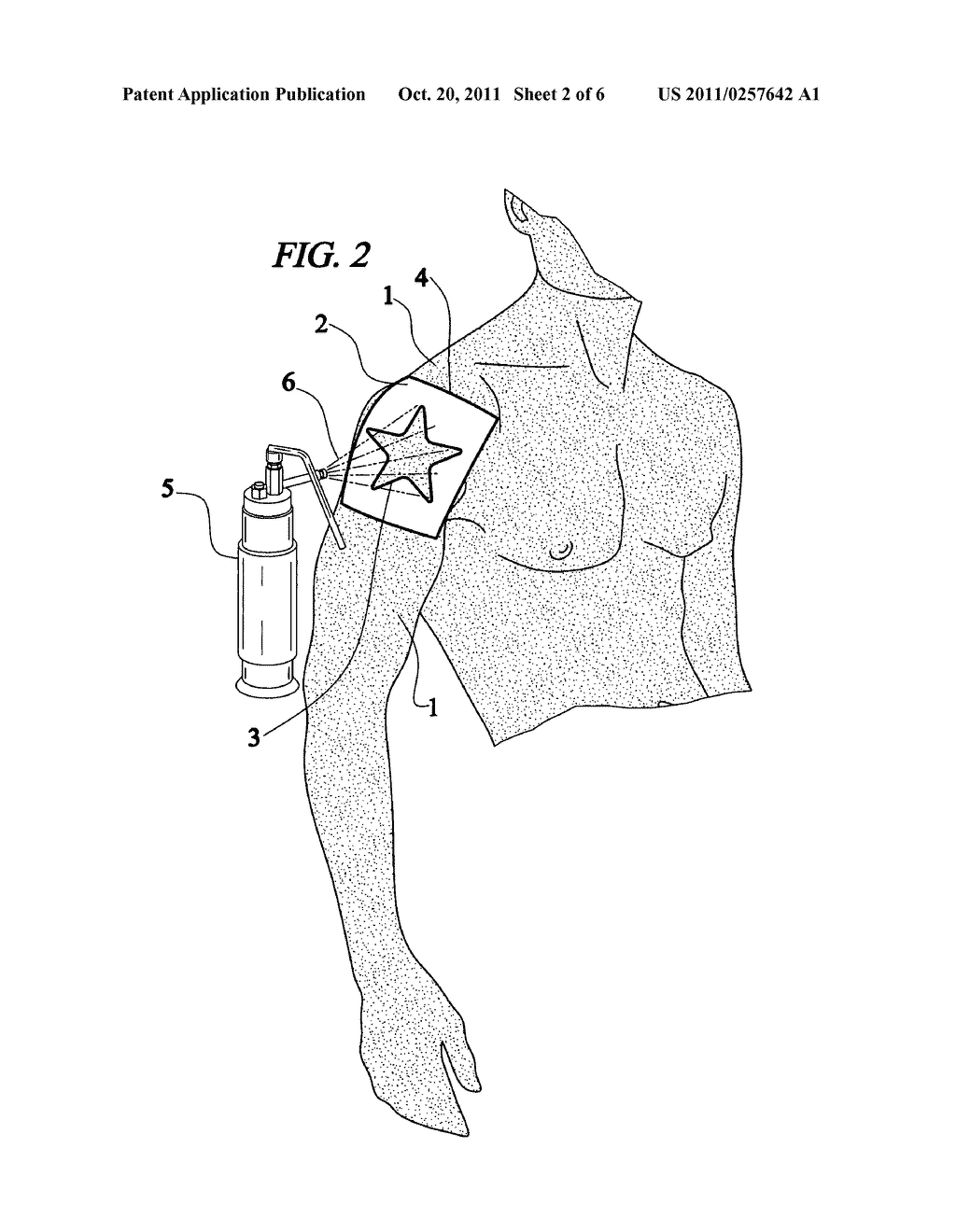 Method for producing a permanent or nearly permanent skin image, design or     tattoo by freezing the skin - diagram, schematic, and image 03