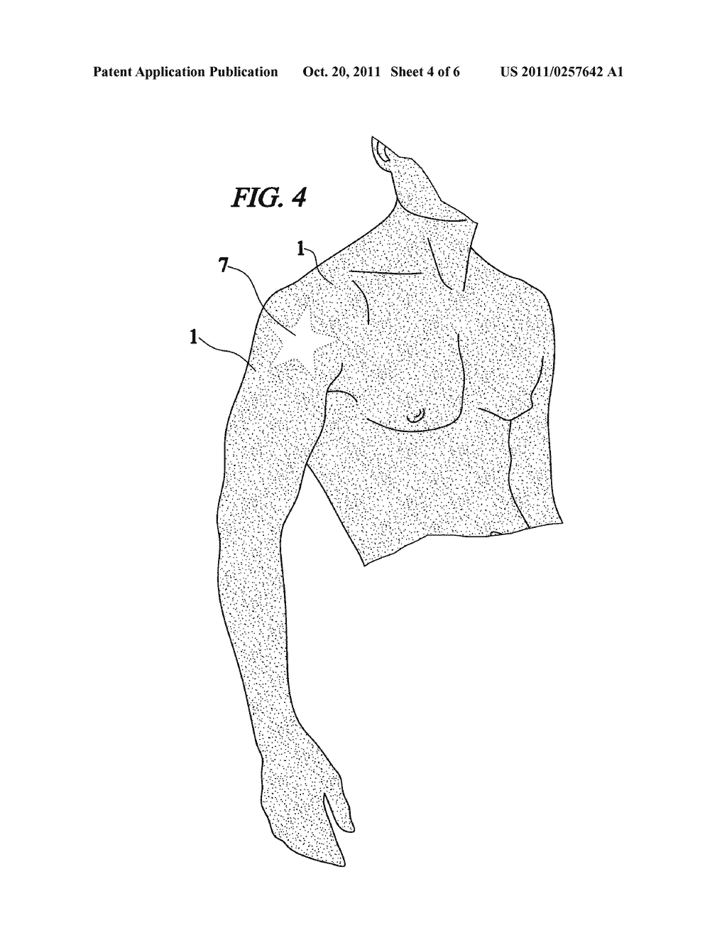 Method for producing a permanent or nearly permanent skin image, design or     tattoo by freezing the skin - diagram, schematic, and image 05