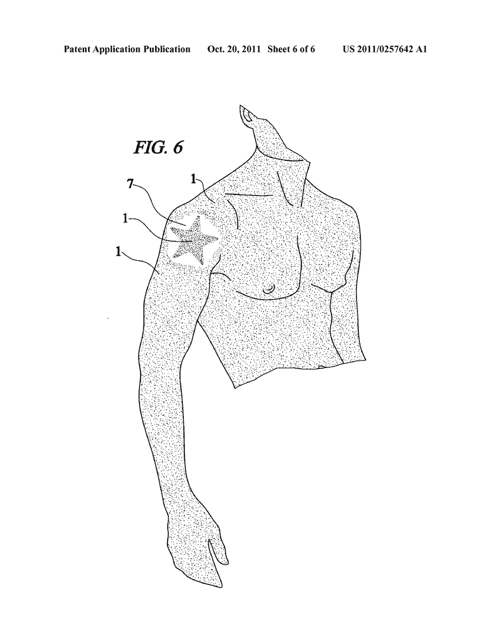 Method for producing a permanent or nearly permanent skin image, design or     tattoo by freezing the skin - diagram, schematic, and image 07