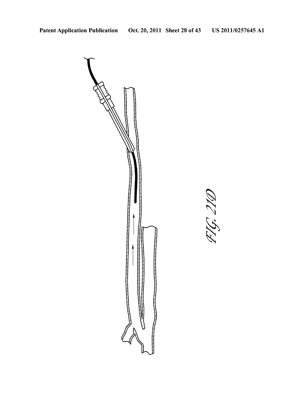 SYSTEMS AND METHODS FOR TREATING A HOLLOW ANATOMICAL STRUCTURE - diagram, schematic, and image 29