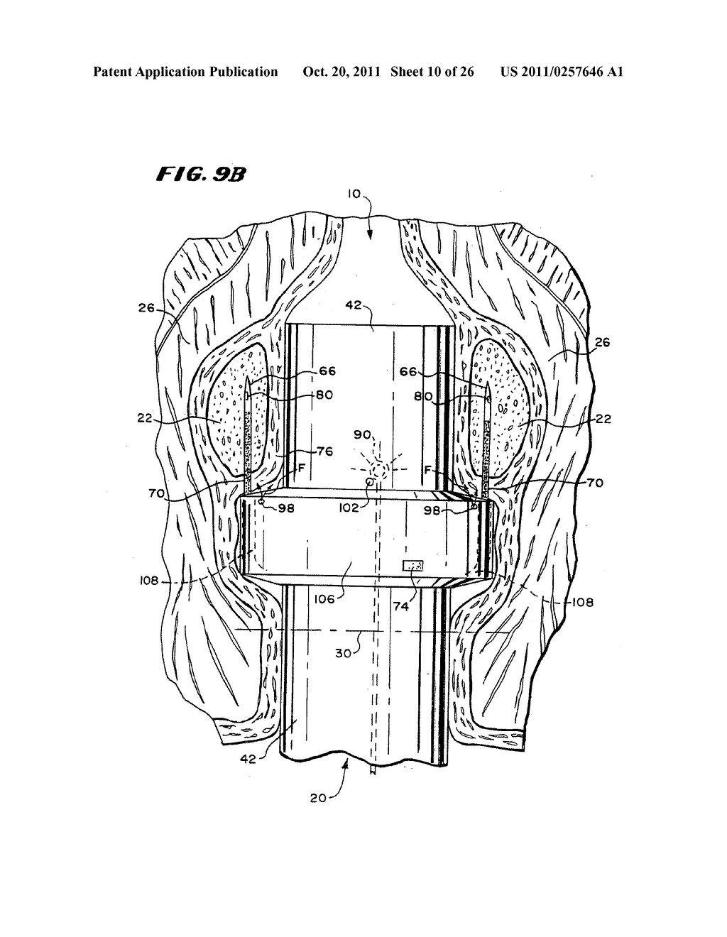 Method for treating fecal incontinence - diagram, schematic, and image 11