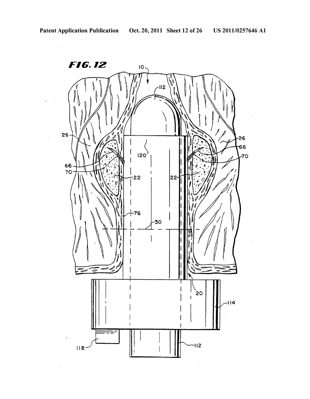 Method for treating fecal incontinence - diagram, schematic, and image 13