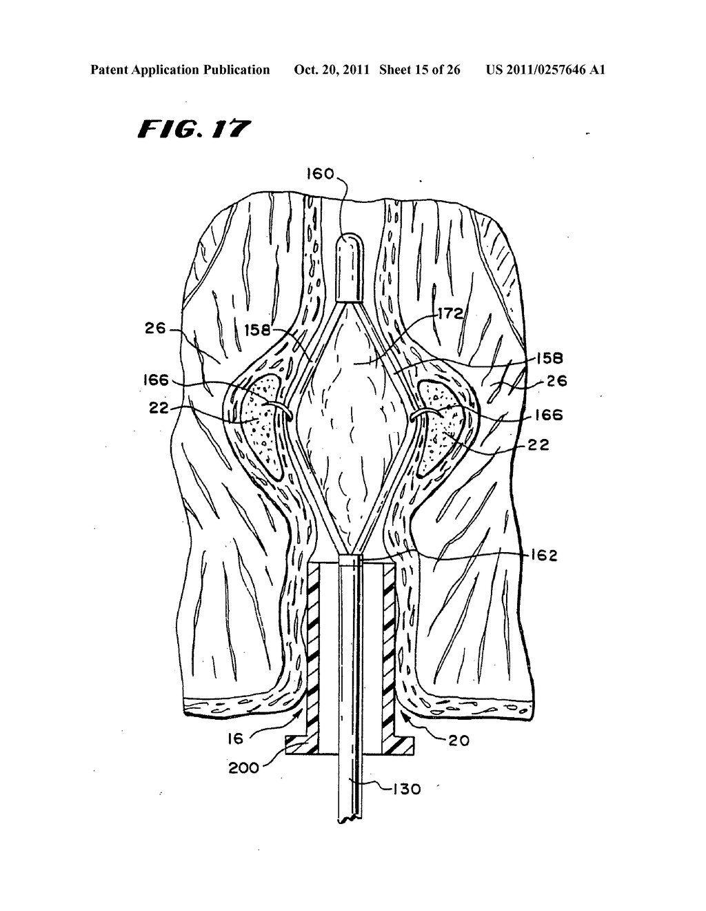 Method for treating fecal incontinence - diagram, schematic, and image 16