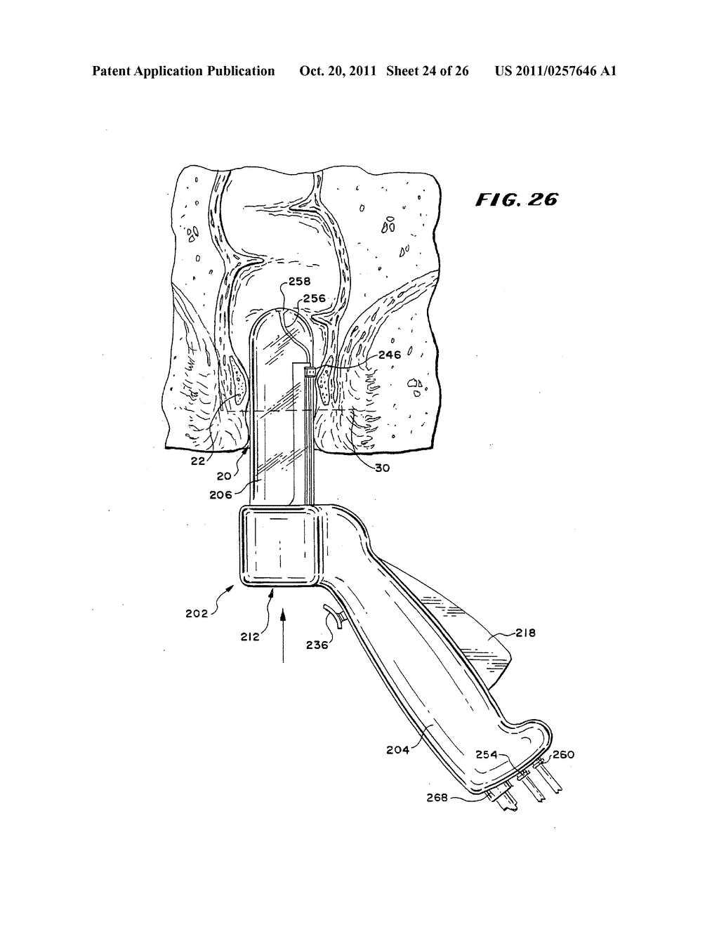 Method for treating fecal incontinence - diagram, schematic, and image 25