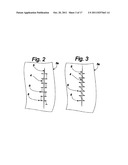 SUTURE SYSTEM FOR MANUAL AND ROBOTIC SURGERY WITH SUTURE THREAD GATHERER     AND FUSER AND DOUBLE POINTED SUTURE NEEDLE FOR ONE HAND APPLICATION (3) diagram and image