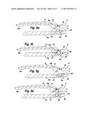 SUTURE SYSTEM FOR MANUAL AND ROBOTIC SURGERY WITH SUTURE THREAD GATHERER     AND FUSER AND DOUBLE POINTED SUTURE NEEDLE FOR ONE HAND APPLICATION (3) diagram and image