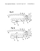 SUTURE SYSTEM FOR MANUAL AND ROBOTIC SURGERY WITH SUTURE THREAD GATHERER     AND FUSER AND DOUBLE POINTED SUTURE NEEDLE FOR ONE HAND APPLICATION (3) diagram and image