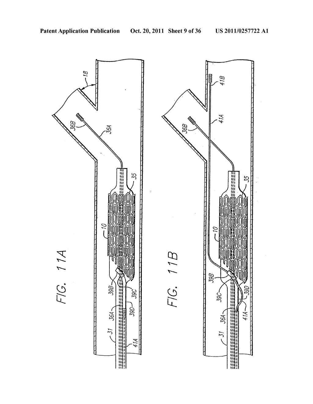 STENT AND CATHETER ASSEMBLY AND METHOD FOR TREATING BIFURCATIONS - diagram, schematic, and image 10