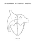 DEVICES AND METHODS FOR CORONARY SINUS PRESSURE RELIEF diagram and image