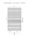 DEVICES AND METHODS FOR CORONARY SINUS PRESSURE RELIEF diagram and image