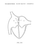 DEVICES AND METHODS FOR CORONARY SINUS PRESSURE RELIEF diagram and image