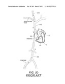 DEVICES AND METHODS FOR CORONARY SINUS PRESSURE RELIEF diagram and image