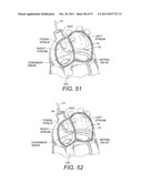 DEVICES AND METHODS FOR CORONARY SINUS PRESSURE RELIEF diagram and image