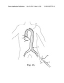 Transcatheter Prosthetic Heart Valve Delivery System and Method with     Expandable Stability Tube diagram and image