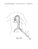 Transcatheter Prosthetic Heart Valve Delivery System and Method with     Expandable Stability Tube diagram and image