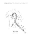 Transcatheter Prosthetic Heart Valve Delivery System and Method with     Expandable Stability Tube diagram and image