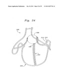 Flexible Heart Valve and Holder Therefor diagram and image