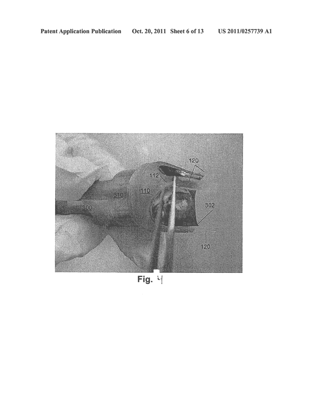 PERCUTANEOUS VALVE DEPLOYMENT - diagram, schematic, and image 07