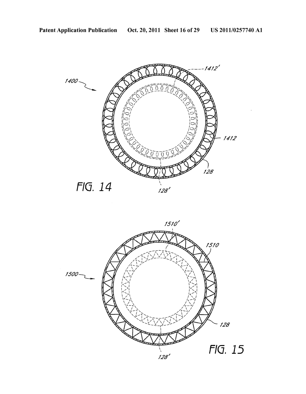 SELECTIVELY ADJUSTABLE CARDIAC VALVE IMPLANTS - diagram, schematic, and image 17