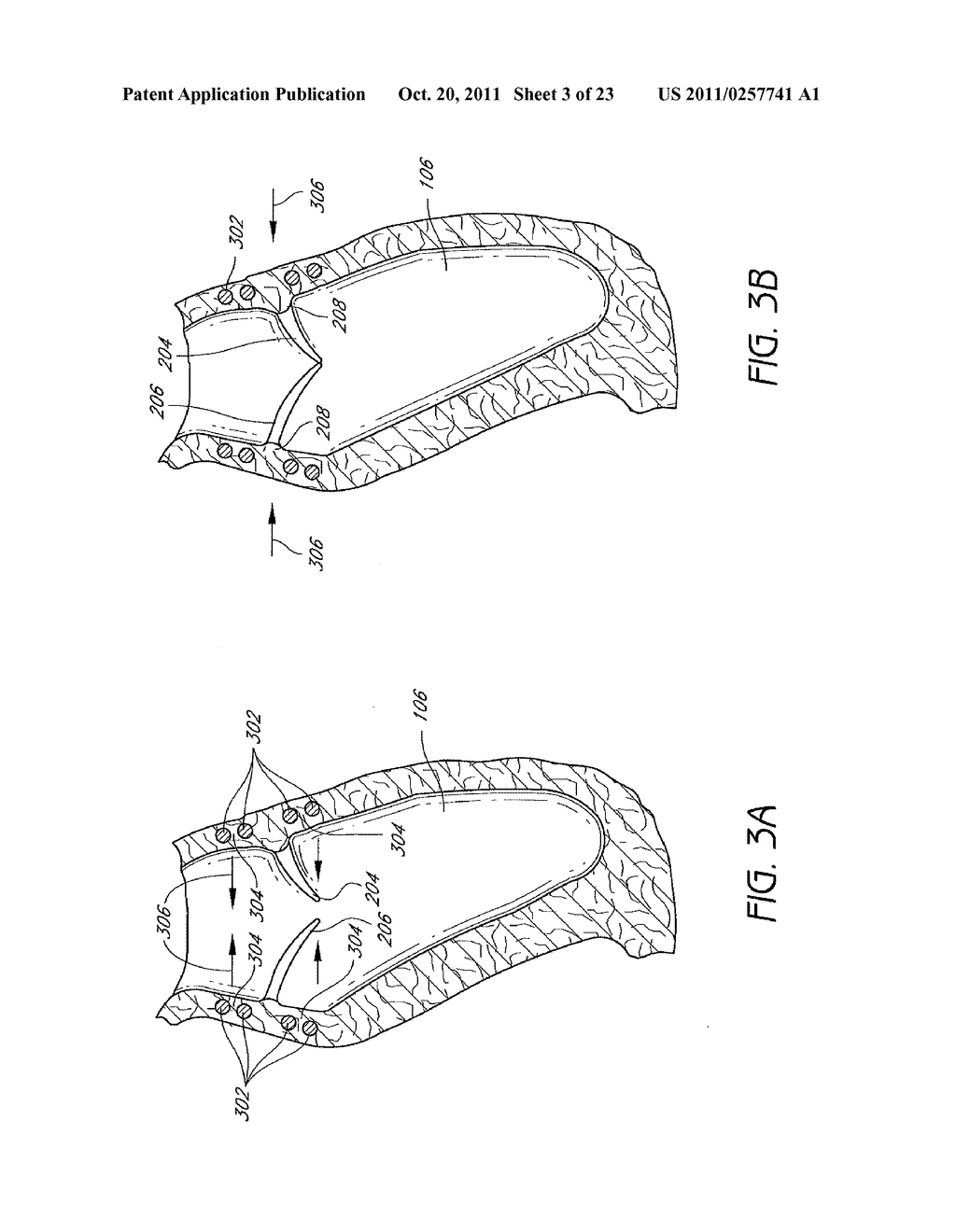 IMPLANTS AND METHODS FOR RESHAPING HEART VALVES - diagram, schematic, and image 04