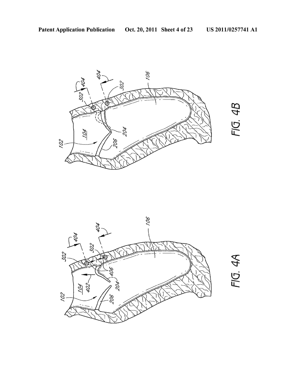 IMPLANTS AND METHODS FOR RESHAPING HEART VALVES - diagram, schematic, and image 05