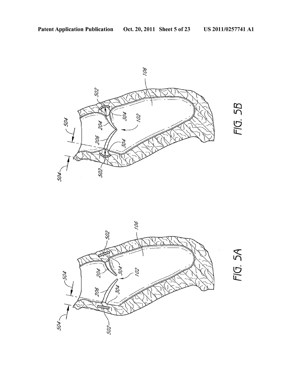 IMPLANTS AND METHODS FOR RESHAPING HEART VALVES - diagram, schematic, and image 06