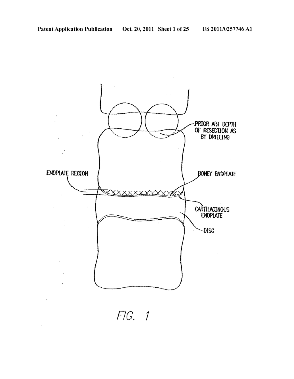 METHOD FOR USING A GUARD FOR CREATING A SOCKET POSTERIORLY IN THE LUMBAR     SPINE - diagram, schematic, and image 02