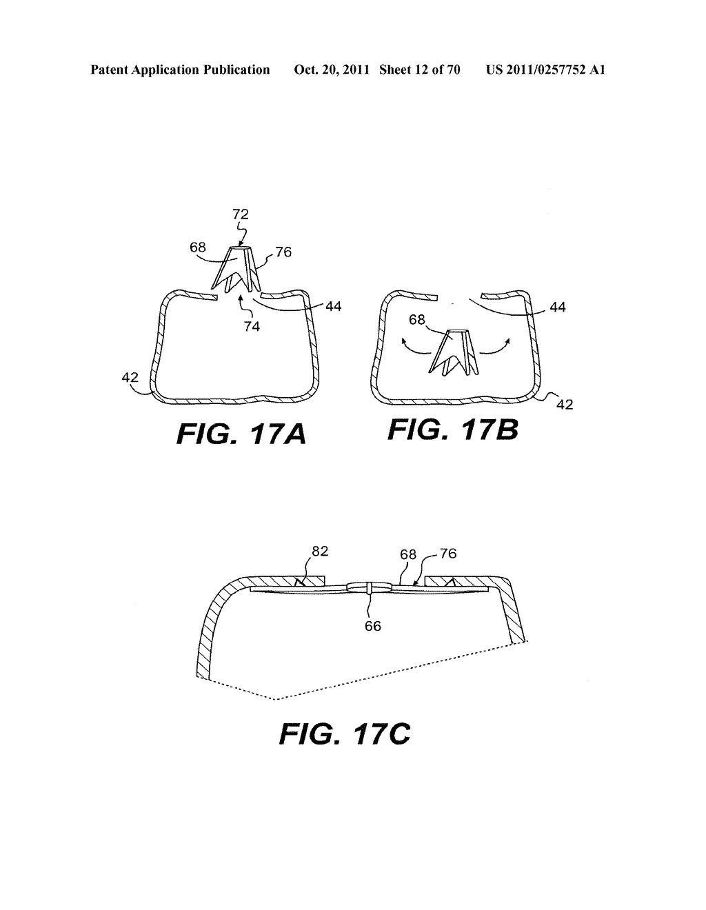 METHODS AND DEVICES FOR SPINAL DISC ANNULUS RECONSTRUCTION AND REPAIR - diagram, schematic, and image 13