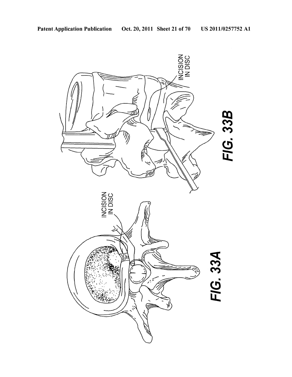 METHODS AND DEVICES FOR SPINAL DISC ANNULUS RECONSTRUCTION AND REPAIR - diagram, schematic, and image 22