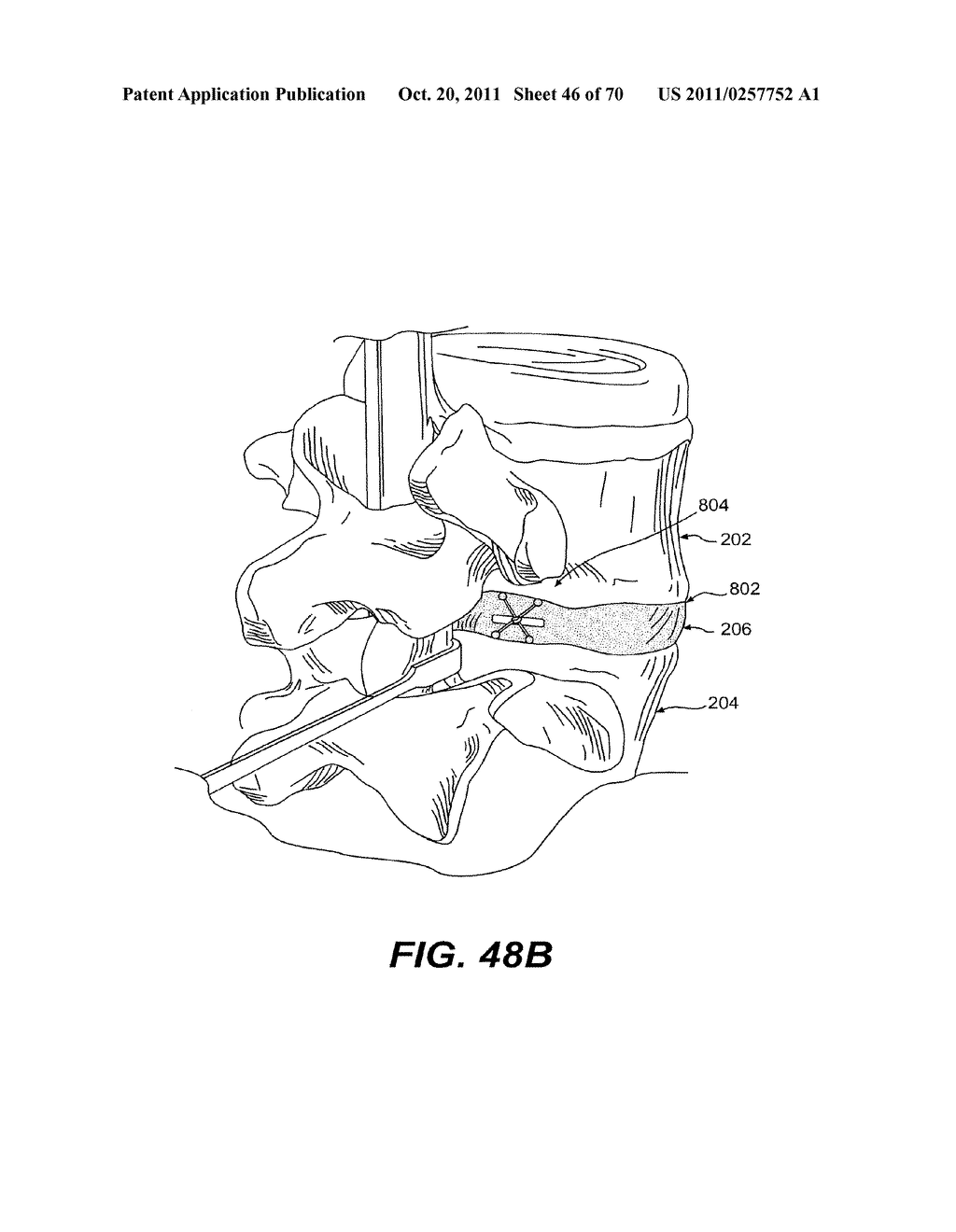 METHODS AND DEVICES FOR SPINAL DISC ANNULUS RECONSTRUCTION AND REPAIR - diagram, schematic, and image 47