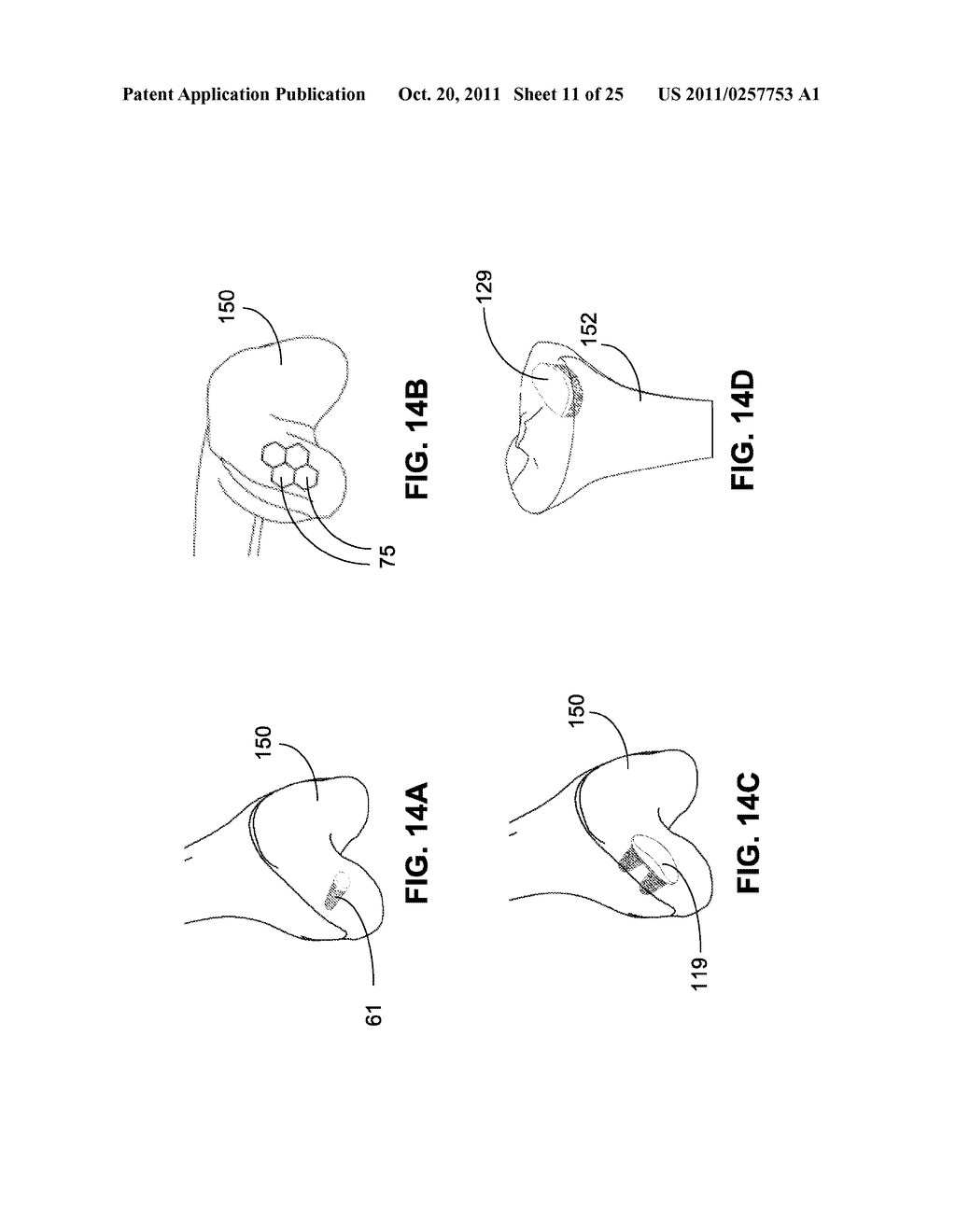 IMPLANT HAVING A CONVEX SURFACE SURROUNDING A CONCAVE ARTICULAR SURFACE - diagram, schematic, and image 12