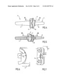 ORTHOPAEDIC IMPLANT FOR ARTHROPLASTY OF THE FINGERS diagram and image