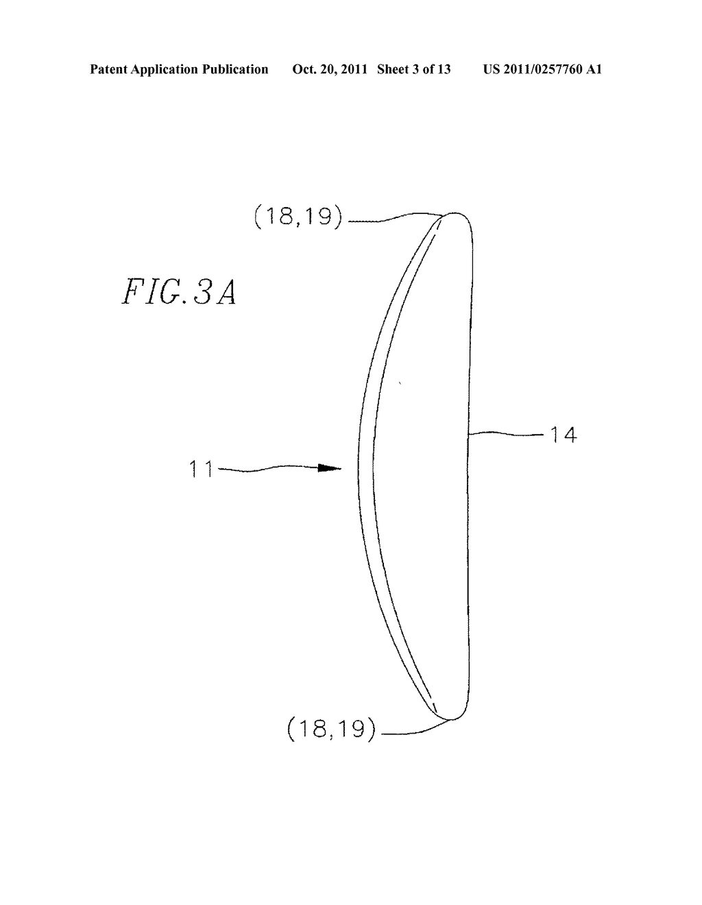 GASTRIC IMPLANT AND METHOD FOR USE OF SAME - diagram, schematic, and image 04