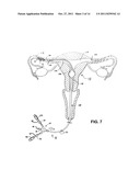 METHODS AND APPARATUS FOR OCCLUDING REPRODUCTIVE TRACTS TO EFFECT     CONTRACEPTION diagram and image