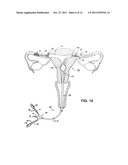 METHODS AND APPARATUS FOR OCCLUDING REPRODUCTIVE TRACTS TO EFFECT     CONTRACEPTION diagram and image