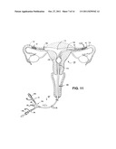 METHODS AND APPARATUS FOR OCCLUDING REPRODUCTIVE TRACTS TO EFFECT     CONTRACEPTION diagram and image