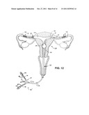 METHODS AND APPARATUS FOR OCCLUDING REPRODUCTIVE TRACTS TO EFFECT     CONTRACEPTION diagram and image