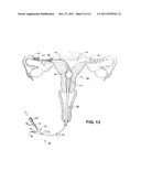 METHODS AND APPARATUS FOR OCCLUDING REPRODUCTIVE TRACTS TO EFFECT     CONTRACEPTION diagram and image