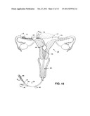 METHODS AND APPARATUS FOR OCCLUDING REPRODUCTIVE TRACTS TO EFFECT     CONTRACEPTION diagram and image