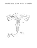 METHODS AND APPARATUS FOR OCCLUDING REPRODUCTIVE TRACTS TO EFFECT     CONTRACEPTION diagram and image