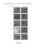 METHOD OF TREATING ACTINIC KERATOSIS WITH 3.75% IMIQUIMOD CREAM diagram and image