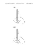 METHOD, DEVICE AND APPARATUS SYSTEM FOR PROSTATE CANCER THERAPY diagram and image