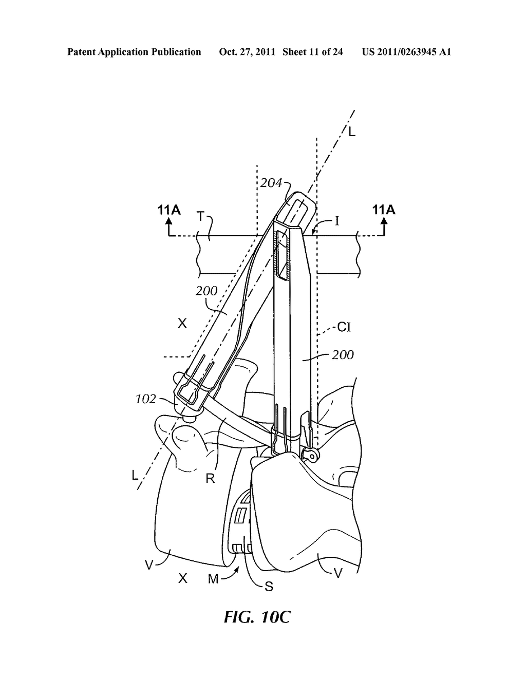 MINIMALLY INVASIVE INSTRUMENT SET, DEVICES AND RELATED METHODS - diagram, schematic, and image 12