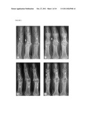  SCORING SYSTEM TO MONITOR NATURAL OR DRUG-MODIFIED DISEASE PROGRESSION IN      EROSIVE OSTEOARTHRITIS  OF THE INTERPHALANGEAL FINGER JOINTS diagram and image